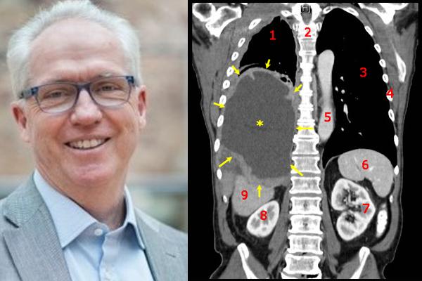 Top Australian cancer researcher visits India Top Australian cancer researcher visits India